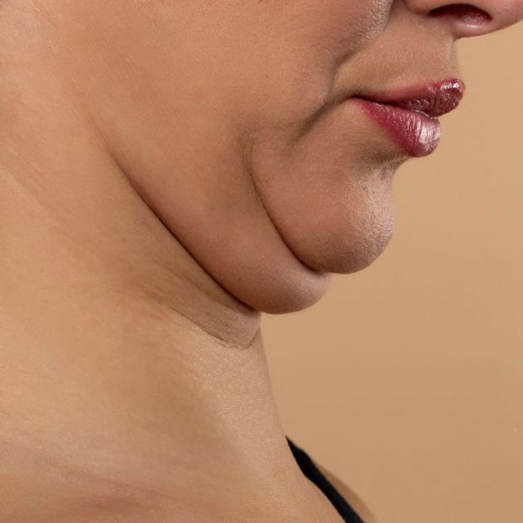Double Chin & Face Puffiness